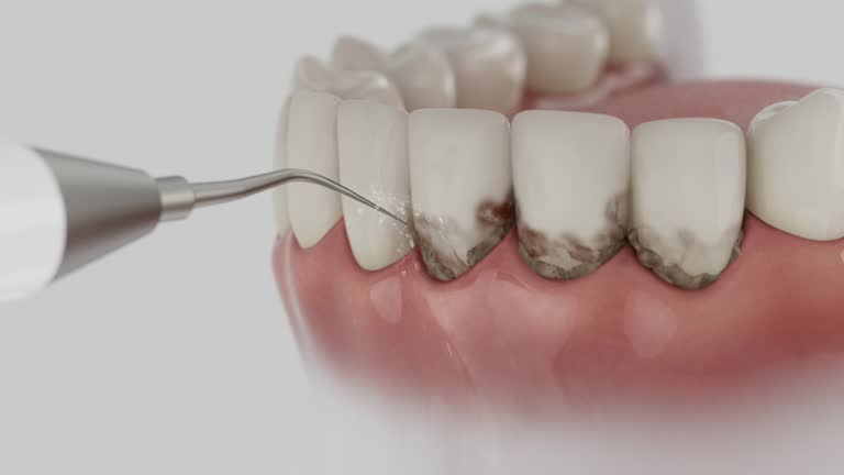 Trusted Wisdom Tooth Removal service in Signal Mountain, TN - Dentist Open Now